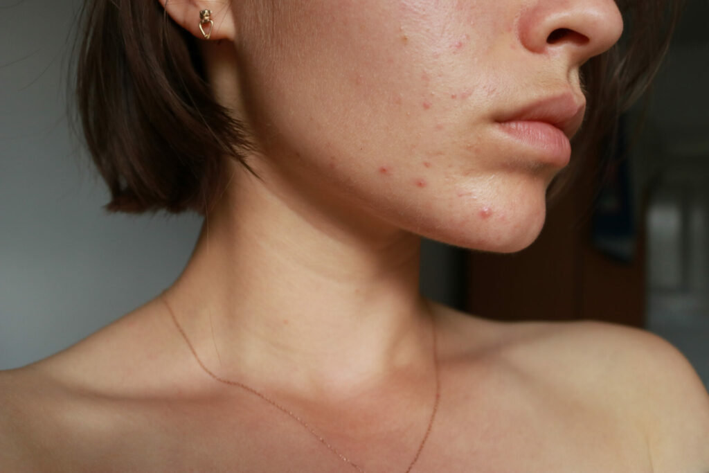 acne