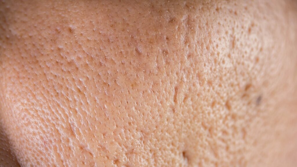 Acne